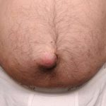 Belly Button Surgery Before & After Patient #1074
