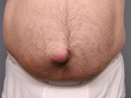 Belly Button Surgery Before & After Patient #1074