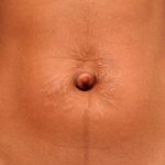 Belly Button Surgery Before & After Patient #1079