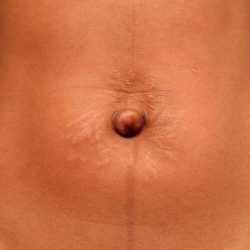 Belly Button Surgery Before & After Patient #1079