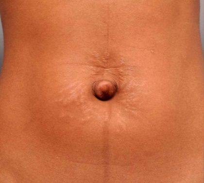 Belly Button Surgery Before & After Patient #1079