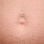Belly Button Surgery Before & After Patient #1084