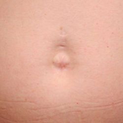 Belly Button Surgery Before & After Patient #1084