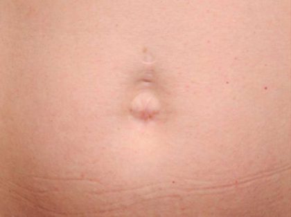Belly Button Surgery Before & After Patient #1084