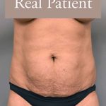 Tummy Tuck Before & After Patient #303