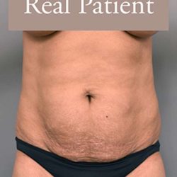 Tummy Tuck Before & After Patient #303
