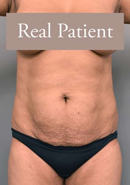 Tummy Tuck Before & After Patient #303