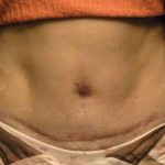Belly Button Surgery Before & After Patient #1089