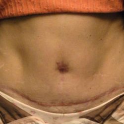 Belly Button Surgery Before & After Patient #1089