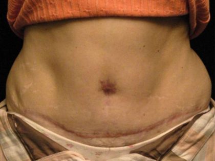 Belly Button Surgery Before & After Patient #1089