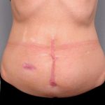 Belly Button Surgery Before & After Patient #1092