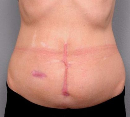 Belly Button Surgery Before & After Patient #1092