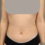 Scarless Rib Contouring (RibXcar) Before & After Patient #1097