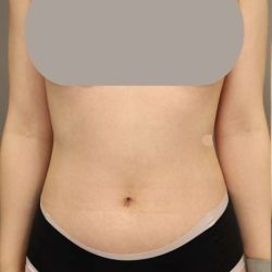 Scarless Rib Contouring (RibXcar) Before & After Patient #1097