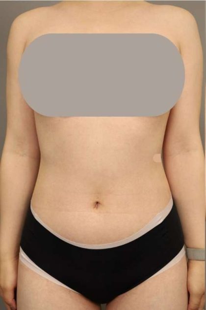 Scarless Rib Contouring (RibXcar) Before & After Patient #1097