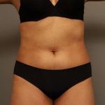 Scarless Rib Contouring (RibXcar) Before & After Patient #1103