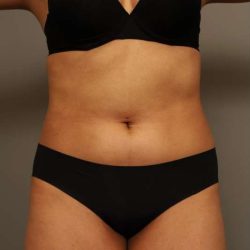 Scarless Rib Contouring (RibXcar) Before & After Patient #1103
