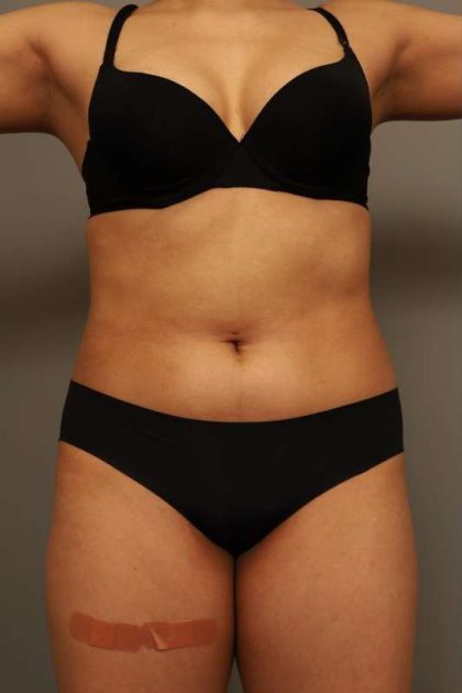 Scarless Rib Contouring (RibXcar) Before & After Patient #1103