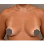 Under The Muscle Breast Augmentation Before & After Patient #1113