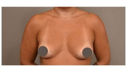 Under The Muscle Breast Augmentation Before & After Patient #1113
