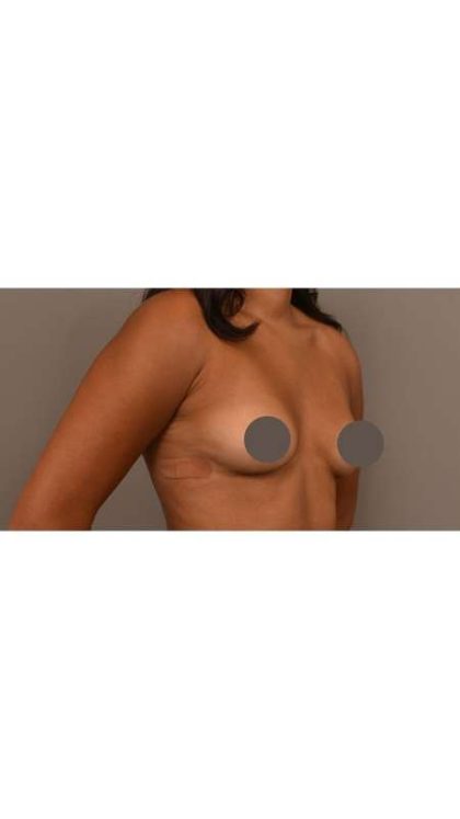Under The Muscle Breast Augmentation Before & After Patient #1116