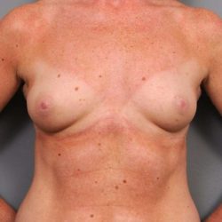 Under The Muscle Breast Augmentation Before & After Patient #1128