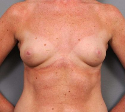 Under The Muscle Breast Augmentation Before & After Patient #1128