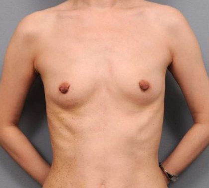 Under The Muscle Breast Augmentation Before & After Patient #1133