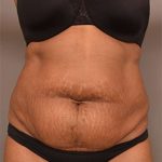 Tummy Tuck Before & After Patient #312
