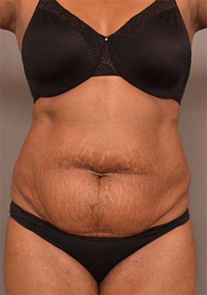 Tummy Tuck Before & After Patient #312