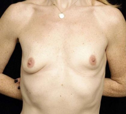 Under The Muscle Breast Augmentation Before & After Patient #1140