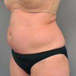 Tummy Tuck Before & After Patient #319