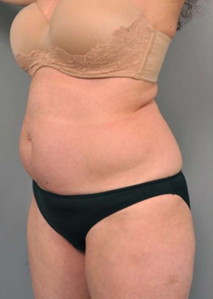 Tummy Tuck Before & After Patient #319