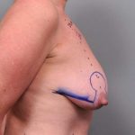 Breast Lift Before & After Patient #1221