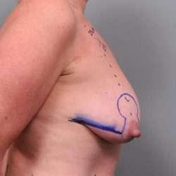 Breast Lift Before & After Patient #1221