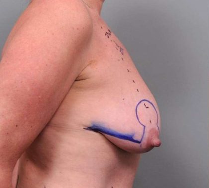 Breast Lift Before & After Patient #1221