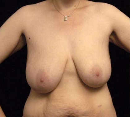 Breast Lift Before & After Patient #1257