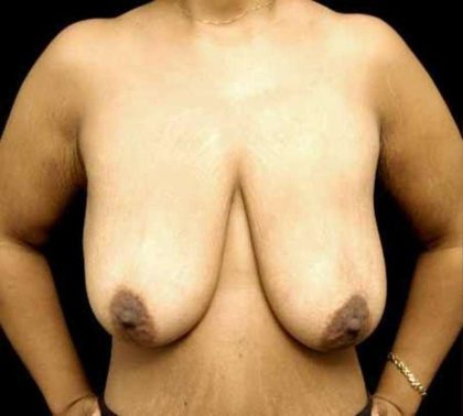 Breast Lift Before & After Patient #1262