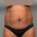 Tummy Tuck Before & After Patient #322