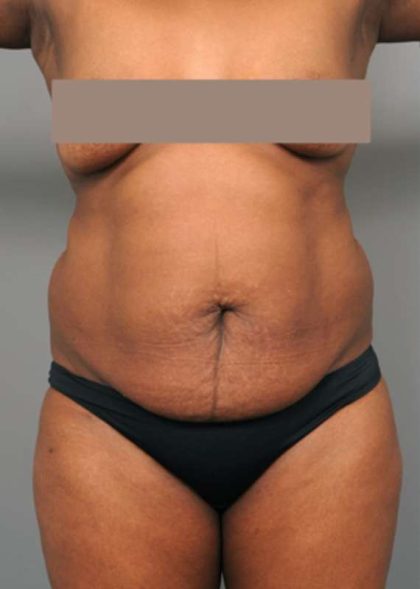 Tummy Tuck Before & After Patient #322