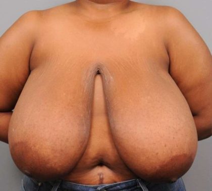 Breast Reduction Before & After Patient #1293