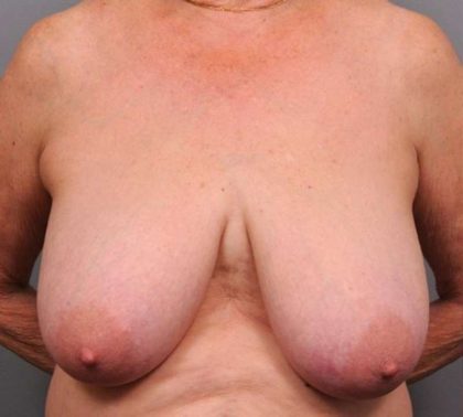 Breast Reduction Before & After Patient #1298