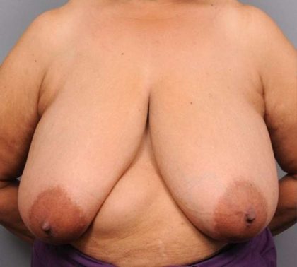 Breast Reduction Before & After Patient #1303