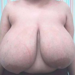 Breast Reduction Before & After Patient #1320