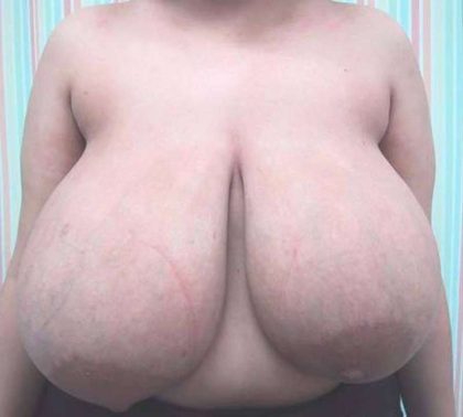 Breast Reduction Before & After Patient #1320