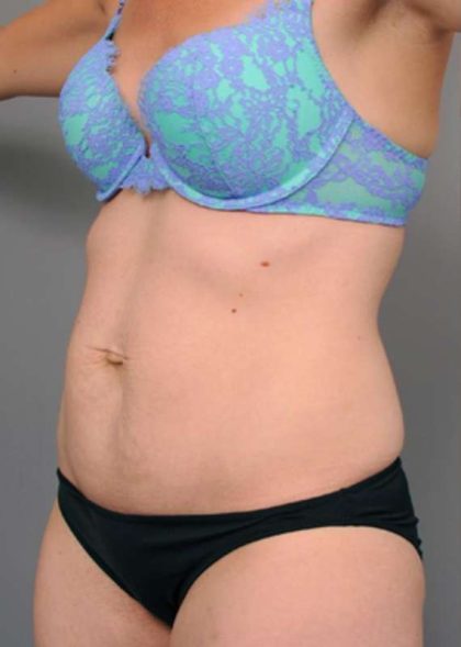 Tummy Tuck Before & After Patient #329