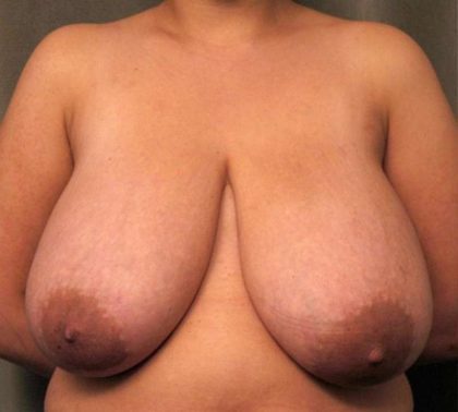 Breast Reduction Before & After Patient #1338