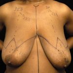 Breast Reduction Before & After Patient #1343