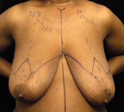 Breast Reduction Before & After Patient #1343