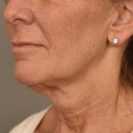 Facelift Before & After Patient #1359